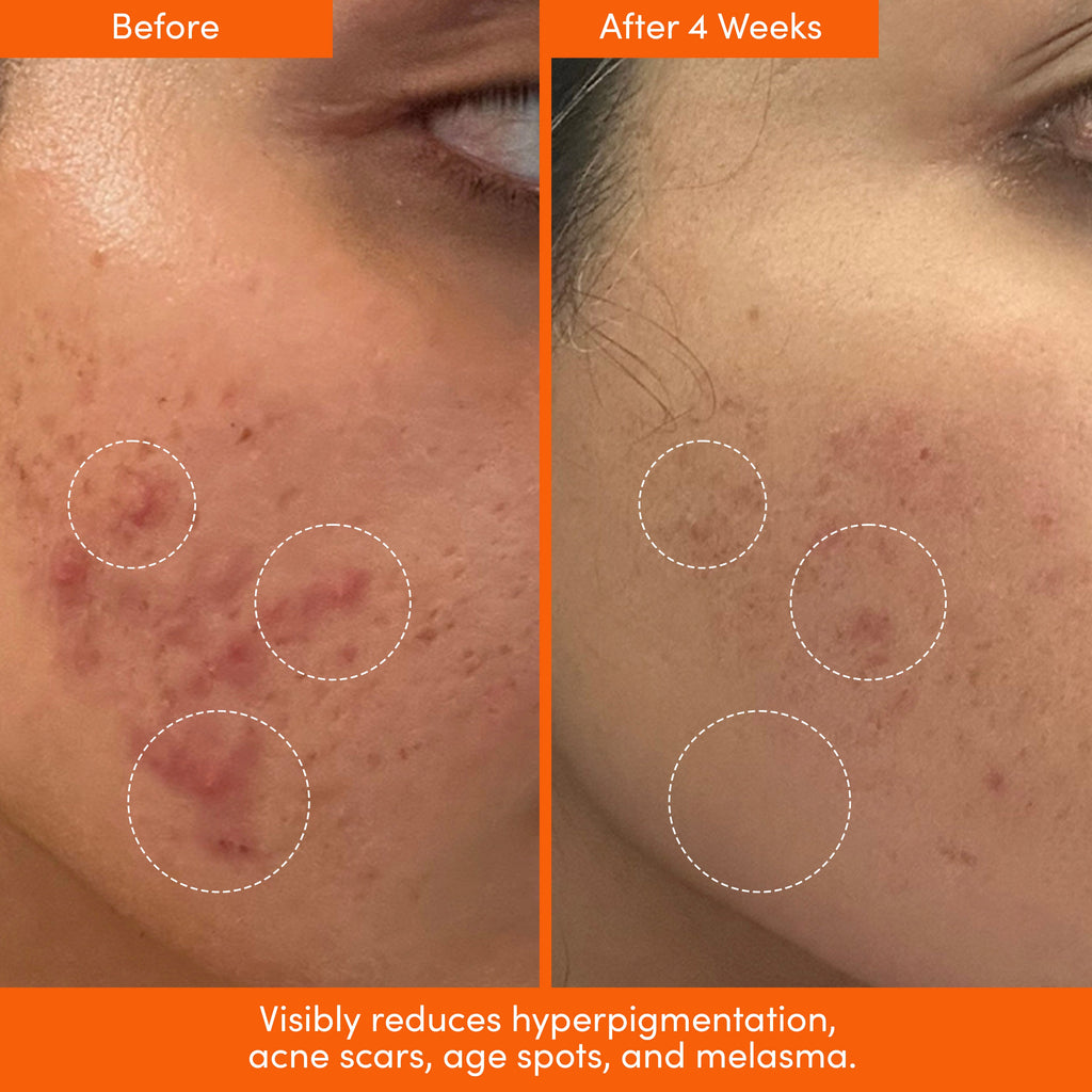 Acid Jelly Serum | UNSPOTTED 4X® Night Serum for Dark Spot Treatment & Skin Brightening